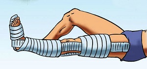 Фиксирование Фиксирование голени