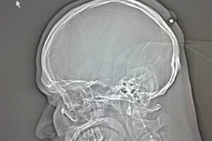 В голове Снаряд в голове