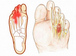 Онемение пальца Онемение пальчика