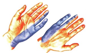 Онемение ручки Онемение ручек