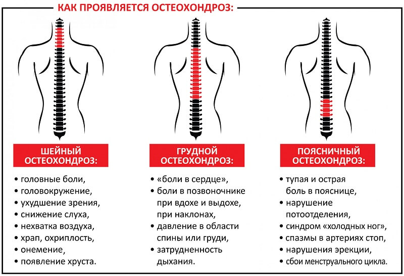 Остеохондроз при онемении Остеохондроз при парестезии