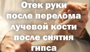 Отечность руки после перелома лучевой кости Отек руки после перелома