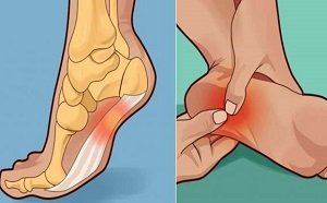 Парестезия пяточек Парестезия пяток