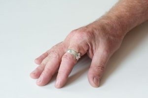 Парестезия у женщин