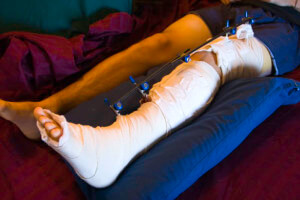 Пациент со сломанной костью