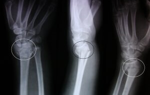 Перелом дистального метаэпифиза