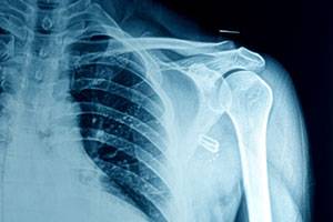 Переломанное плечо