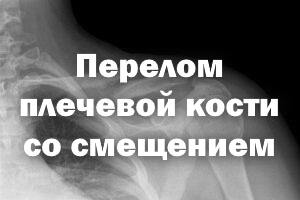 Перелом плеча со смещением Перелом плечевой кости со смещением