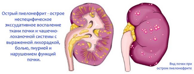 Болезнь Пиелонефрит