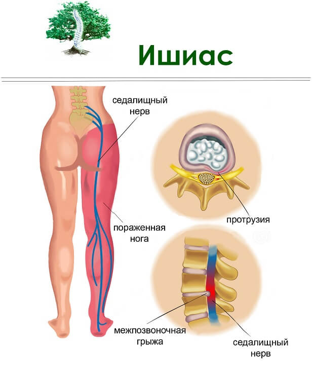 Заболевание Болезнь ишиас