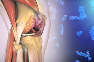 Повреждение коленки Травма коленки