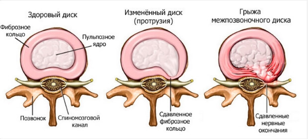 Грыжа Грыжа межпозвоночного диска