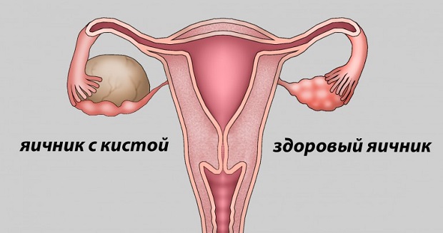 Серьезная проблема Киста