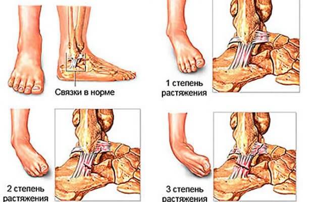 Растянул Растяжение