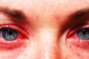 Раздражение глазах Раздражение в глазках