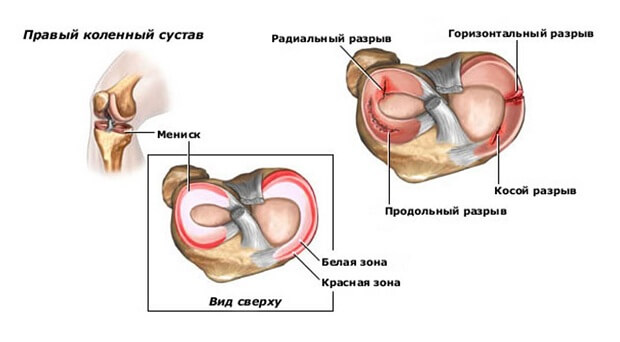 Разрыв Разрыв мениска