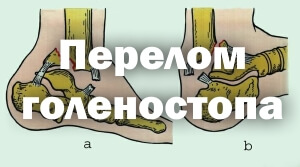Сломанный голеностоп Перелом голеностопа