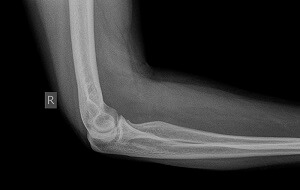 Рентген перелома руки