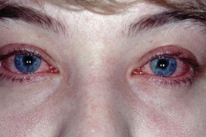 Болезнь Заболевание