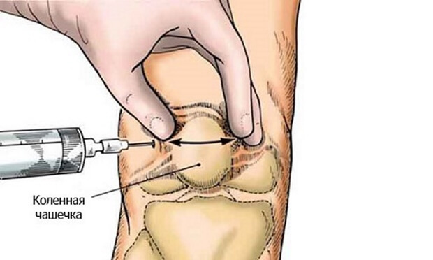 Обезболивание Для обезболивания