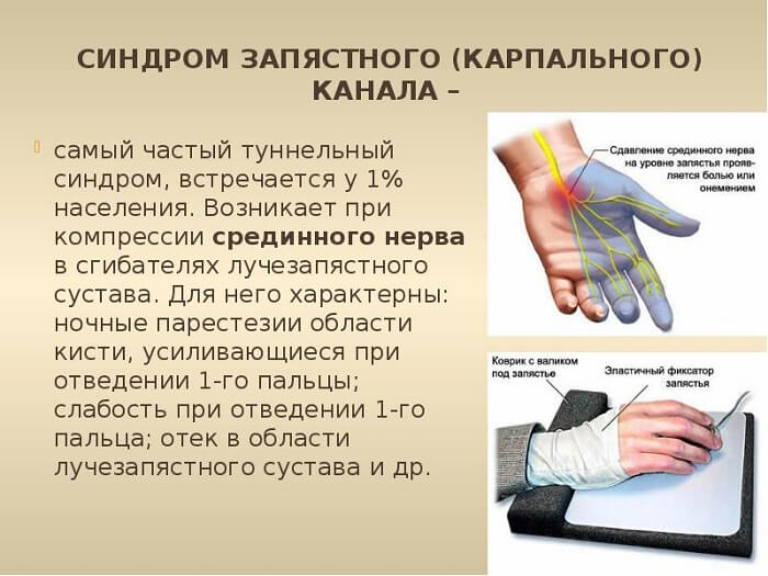Синдром карпального канала Синдром запястного канала