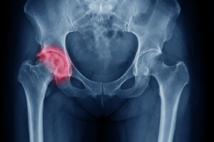 Сломанная кость