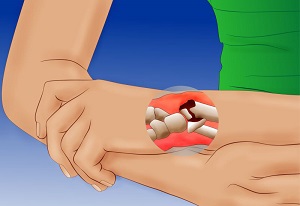 Сломанная ручка Сломанная рука