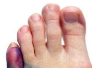 Сломанный мизинчик Поломанный мизинчик