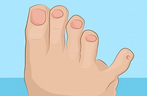 Сломанный мизинчик Поломанный мизинчик