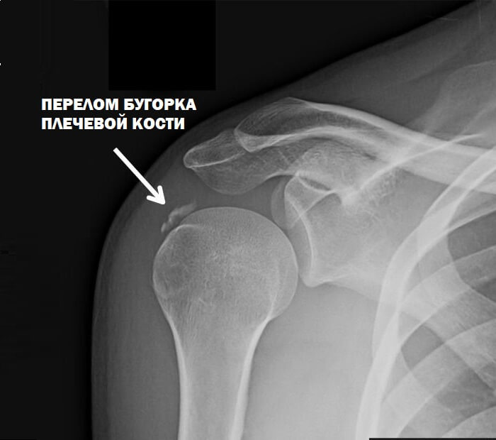 Снимок перелома бугорка Как выглядит перелом бугорка на снимке