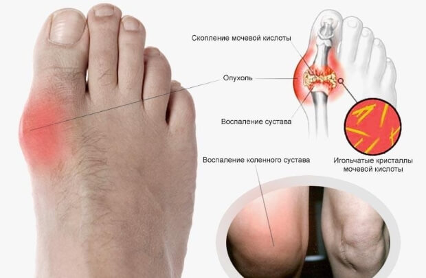 Поражение Поражение суставов подагрой