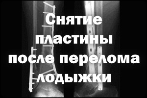 Удаление пластины после перелома Снятие пластины после перелома лодыжки