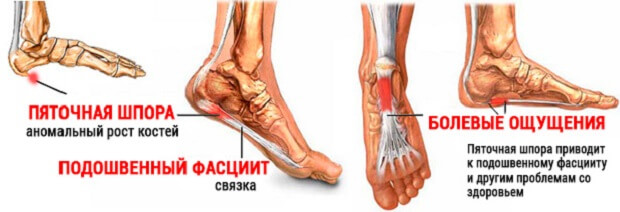 Фасцит Шпора и фасцит