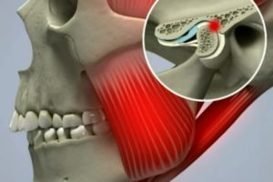 Сустав челюсти человека Сустав челюсти больного