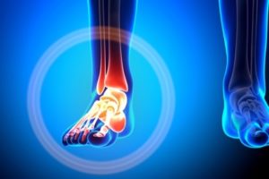 Сустав стопы человека Сустав стопы больного
