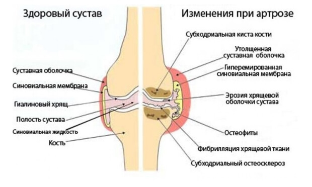 Заболевание Артроз