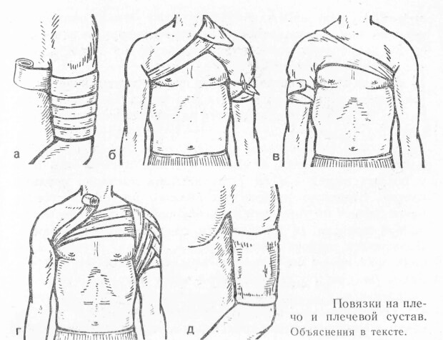 Повязка Наложение фиксирующей повязки на плечо