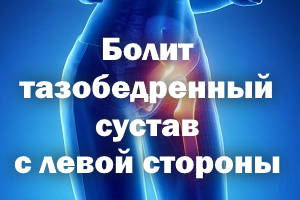 Болит тазобедренный сустав с левой стороны Болит тазобедренный сустав слева