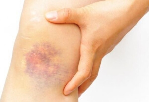 Патология На ноге