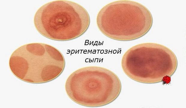 Сыпь Пурпуровая сыпь