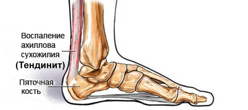 Тендинит лодыжки Тендинит ноги