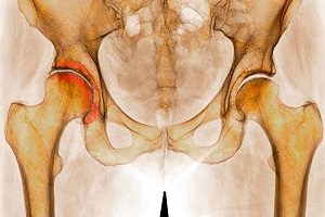 Трещина бедра Трещинка бедра