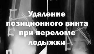 Как снимают позиционный винт при переломе лодыжки Удаление позиционного винта при переломе лодыжки