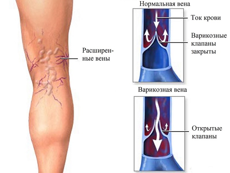 Варикозное расширение вен Варикоз ног