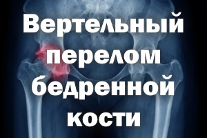 Вертельный перелом бедра Вертельный перелом бедренной кости