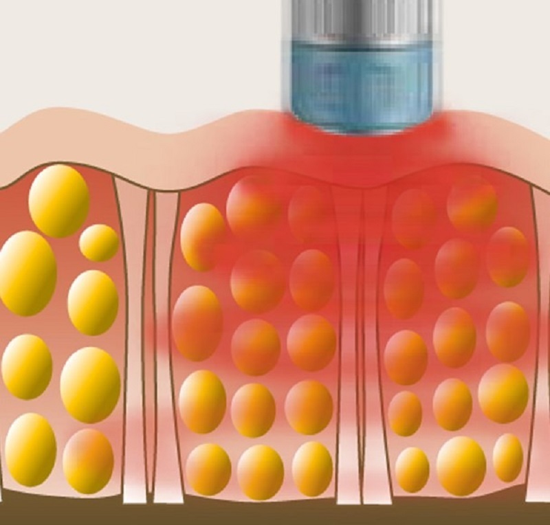 Влияние лазера Влияние аппарата УВТ