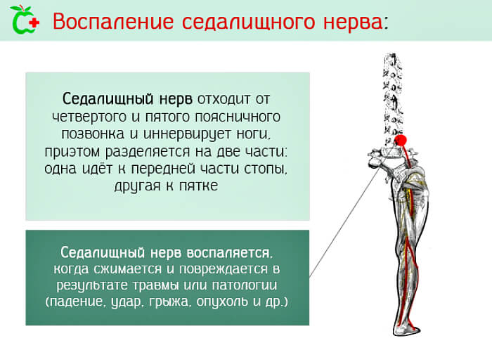 Поменять Воспаление седалищного нерва