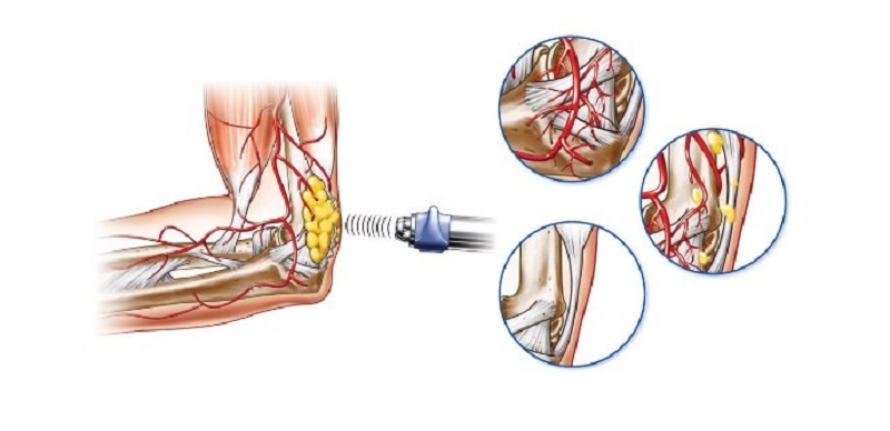 Воздействие лазера Воздействие аппарата УВТ