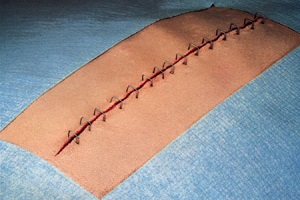 Закрытая рана Зашитая рана